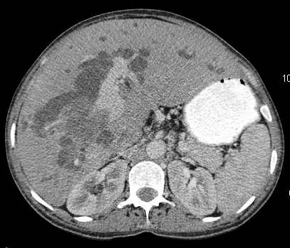 Figure 13: Image showing gross intra hepatic biliary radical dilatation and direct invasion of right main portal vein.